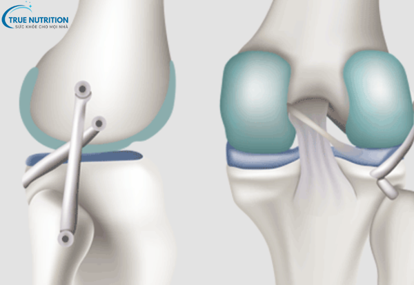 Nội Soi Khớp Gối: Phương Pháp Chẩn Đoán Và Điều Trị Các Bệnh Lý Khớp