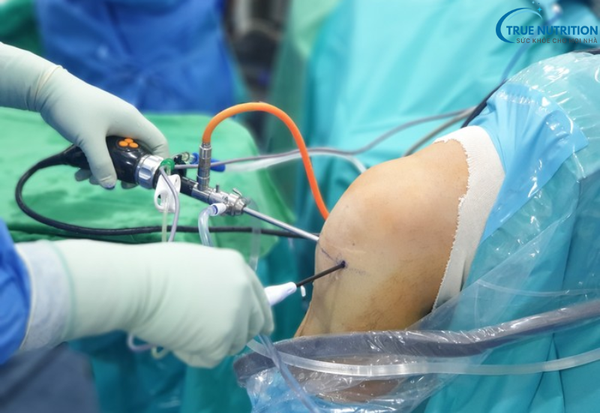 Nội Soi Khớp Gối: Phương Pháp Chẩn Đoán Và Điều Trị Các Bệnh Lý Khớp