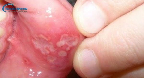 Nhận Định Hình Ảnh Bị Lở Miệng: Phân Biệt, Cách Điều Trị