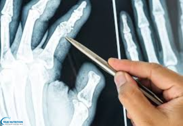 Ghép Xương Là Gì? Giải Pháp Tái Tạo Và Phục Hồi Xương Sau Chấn ThươngGhép Xương Là Gì? Giải Pháp Tái Tạo Và Phục Hồi Xương Sau Chấn Thương