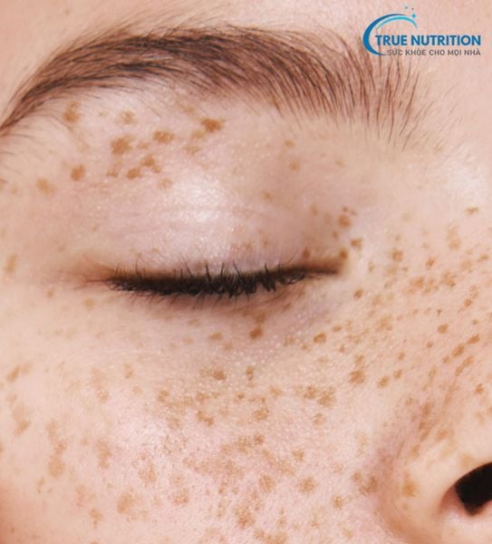 Bớt Hori Là Gì, Có Chữa Được Không, Xuất Hiện Ở Độ Tuổi Nào?