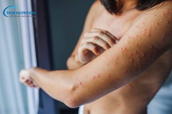 Nổi mụn nhiều có phải bệnh gan không?