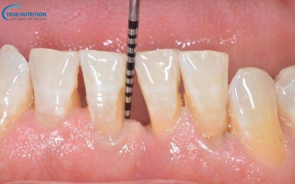 Cách Điều Trị Tụt Nướu Răng Tại Nhà: An Toàn & Hiệu Quả