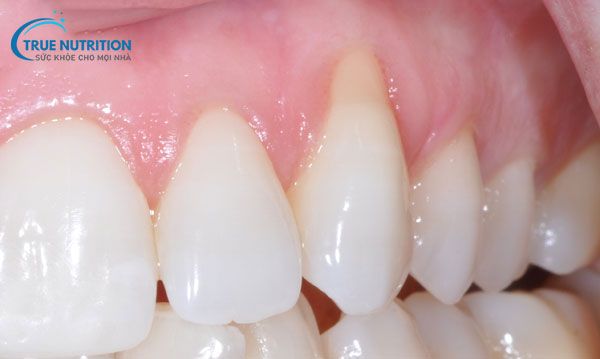 Cách Điều Trị Tụt Nướu Răng Tại Nhà: An Toàn & Hiệu Quả