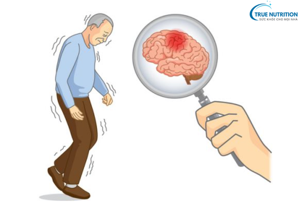 Bệnh Parkinson: Điều Cần Biết và Phương Pháp Điều Trị Hiệu Quả Nhất