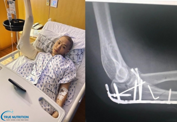 Phẫu Thuật Gãy Xương: Giải Pháp Tối Ưu Cho Việc Hồi Phục Nhanh Chóng