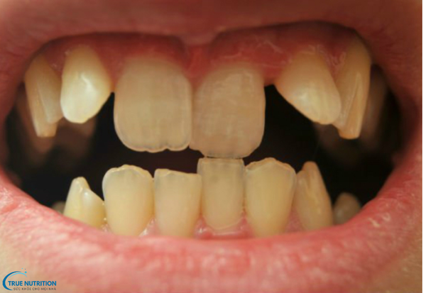 Răng Mọc Lệch, Chen Chúc: Giải Pháp Khắc Phục Tình Trạng Răng Miệng