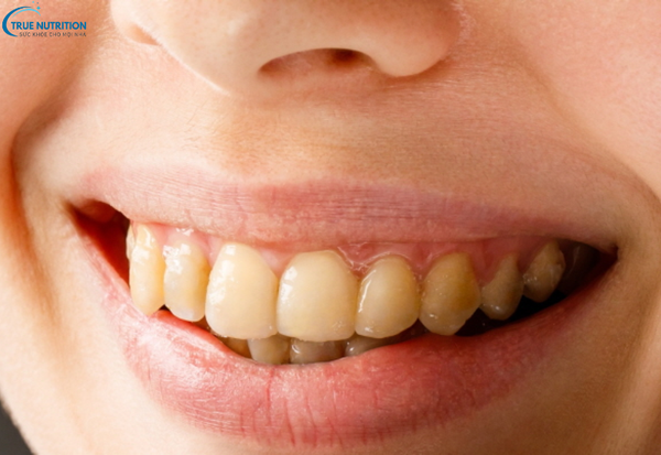 Cách Trị Răng Xỉn Màu: Bí Quyết Cho Nụ Cười Trắng Sáng Suốt Cả Ngày
