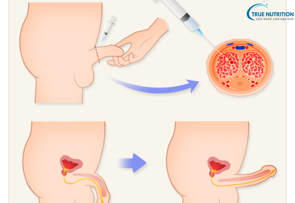 Rối Loạn Cương Dương: Cách Phòng Ngừa Giúp Nam Giới Khỏe Mạnh