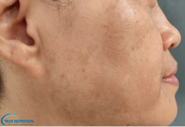 Bệnh Sạm Da Là Gì? Nguyên Nhân, Biểu Hiện và Cách Khắc Phục Hiệu Quả