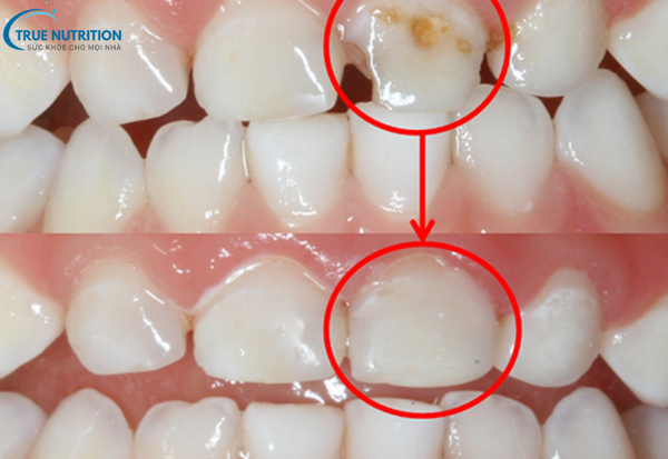 Sâu Răng Là Gì? Cách Nhận Diện Sớm và Ngăn Ngừa Biến Chứng