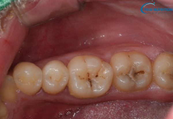 Sâu Răng Là Gì? Cách Nhận Diện Sớm và Ngăn Ngừa Biến Chứng