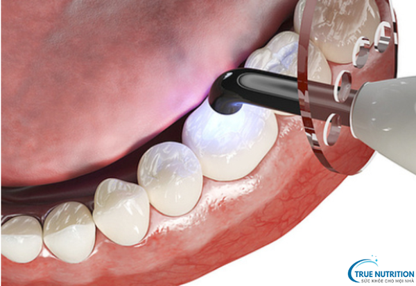 Sâu Răng Là Gì? Cách Nhận Diện Sớm và Ngăn Ngừa Biến Chứng