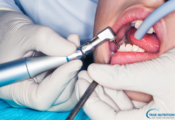 Sâu Răng Là Gì? Cách Nhận Diện Sớm và Ngăn Ngừa Biến Chứng