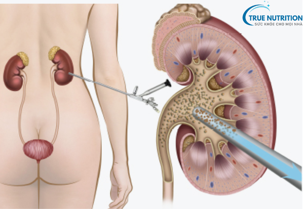 Sỏi Thận: Dấu Hiệu Cảnh Báo và Phương Pháp Loại Bỏ An Toàn
