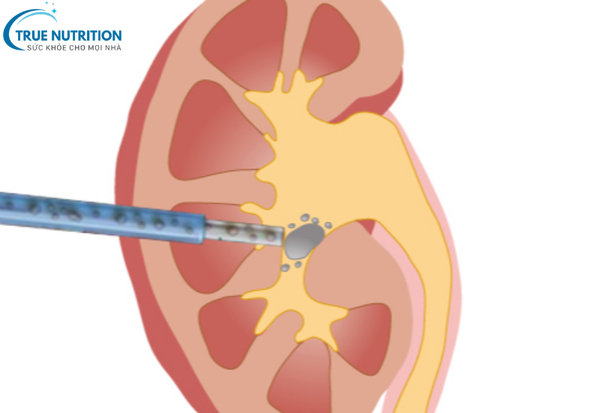 Sỏi Thận: Dấu Hiệu Cảnh Báo và Phương Pháp Loại Bỏ An Toàn