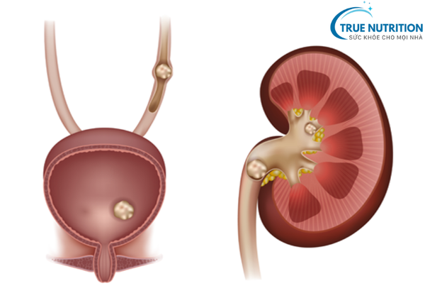 Sỏi Thận: Dấu Hiệu Cảnh Báo và Phương Pháp Loại Bỏ An Toàn