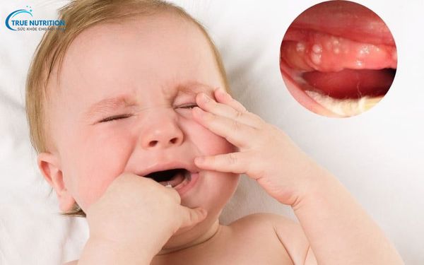 Hình Ảnh Nanh Sữa Ở Trẻ Sơ Sinh: Hình Thái, Xử Lý