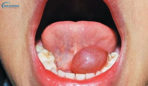Dưới Lưỡi Nổi Cục Thịt: Nguyên Nhân, Điều Trị, Bệnh Lý