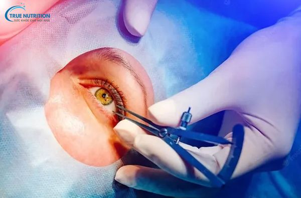 Tác Hại Của Việc Mổ Mắt Cận Thị: Những Điều Cần Biết Trước Khi Quyết Định Phẫu Thuật
