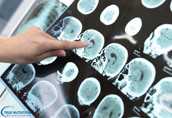 tầm soát đột quỵ