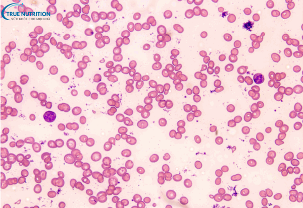 Bệnh Tan Máu Bẩm Sinh : Cách Phòng Ngừa và Tầm Soát Bệnh Đúng Cách