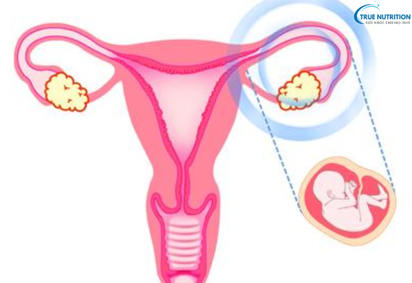 Dấu Hiệu Thai Ngoài Tử Cung: Cách Nhận Biết Sớm Để Bảo Vệ Thai Phụ