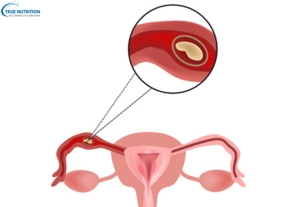 Dấu Hiệu Thai Ngoài Tử Cung: Cách Nhận Biết Sớm Để Bảo Vệ Thai Phụ