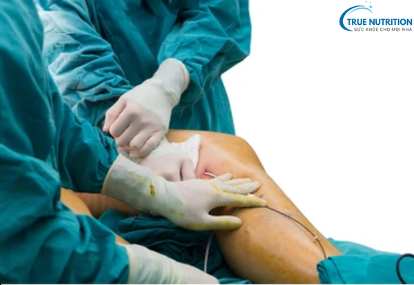 Thay Khớp Gối: Giải Pháp Đột Phá Giúp Khôi Phục Sức Khỏe và Cuộc Sống