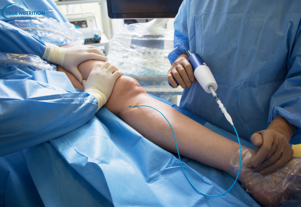 Thay Khớp Gối: Giải Pháp Đột Phá Giúp Khôi Phục Sức Khỏe và Cuộc Sống