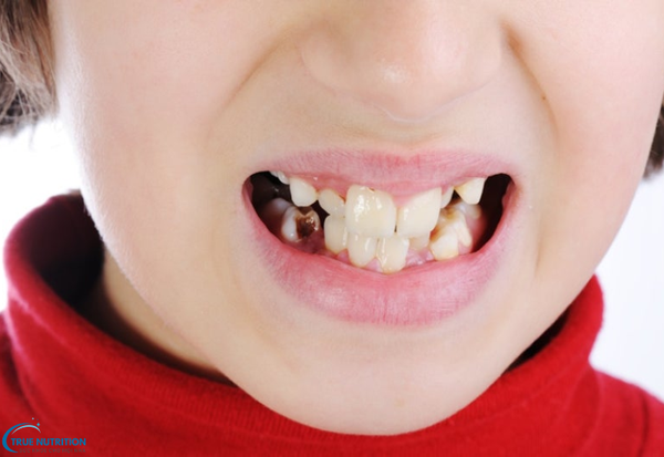 Bệnh Răng Lệch Có Thể Điều Trị Như Thế Nào? Giải Pháp Và Cách Khắc Phục