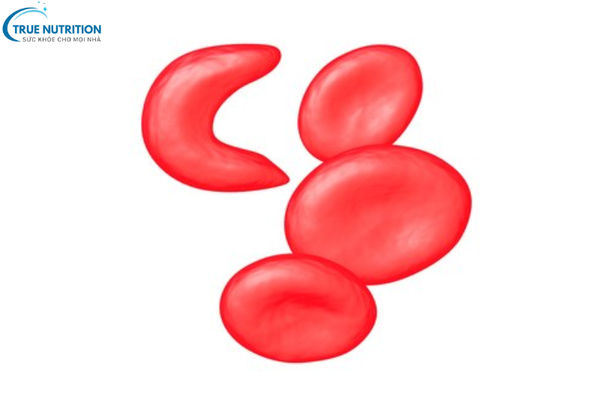 Bệnh Thiếu Máu Hồng Cầu Hình Liềm và Các Biện Pháp Phòng Ngừa hiệu quả