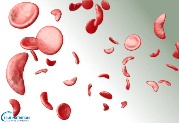 Bệnh Thiếu Máu Hồng Cầu Hình Liềm và Các Biện Pháp Phòng Ngừa hiệu quả