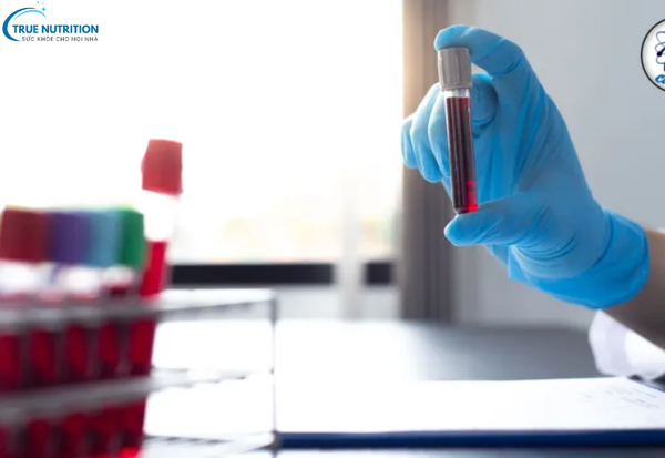 Bệnh Thiếu Máu Hồng Cầu Hình Liềm và Các Biện Pháp Phòng Ngừa hiệu quả