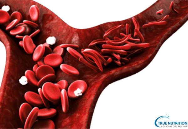 Bệnh Thiếu Máu Hồng Cầu Hình Liềm và Các Biện Pháp Phòng Ngừa hiệu quả
