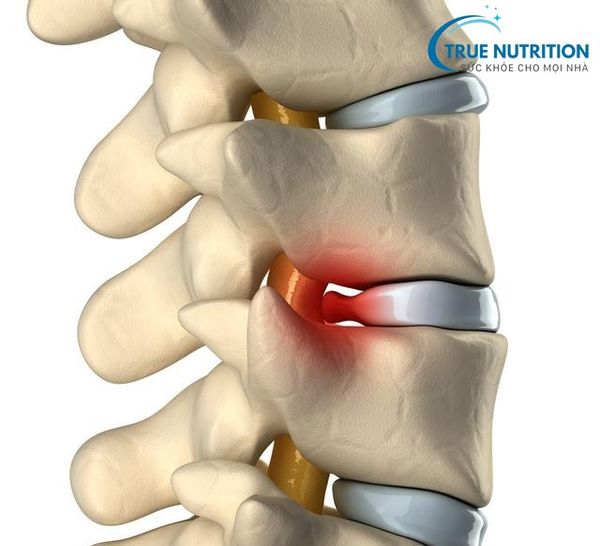 Bệnh thoát vị đĩa đệm