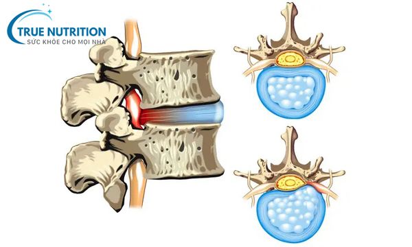 Bệnh thoát vị đĩa đệm