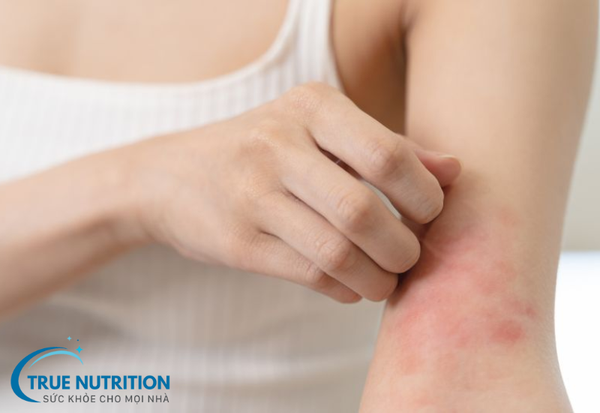 Top 3 nguyên nhân gây dị ứng thức ăn và cách phòng ngừa hiệu quả