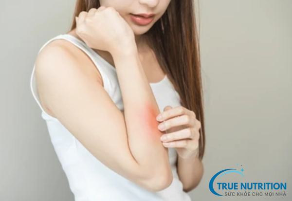 Top 3 nguyên nhân gây dị ứng thức ăn và cách phòng ngừa hiệu quả