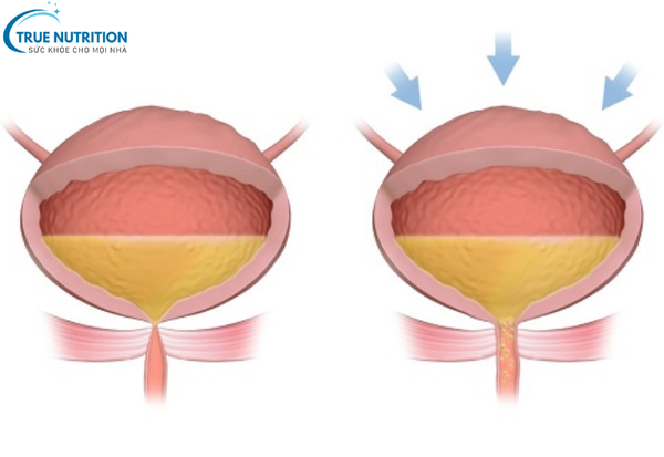 Tiểu Không Tự Chủ:&nbsp; Điều Cần Biết để Kiểm Soát và Phòng Ngừa Hiệu Quả