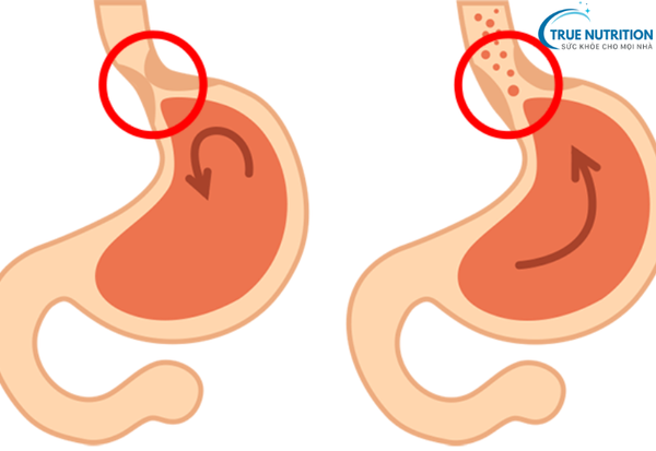 Trào Ngược Dạ Dày Thực Quản: Nhận Biết và Kiểm Soát Bệnh Từ A đến Z