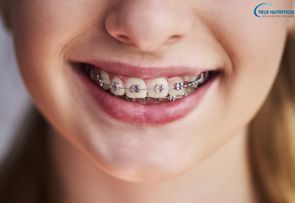 Bệnh Răng Vẩu Nặng Là Gì? Cách Điều Trị Giúp Lấy Lại Nụ Cười Tự Tin
