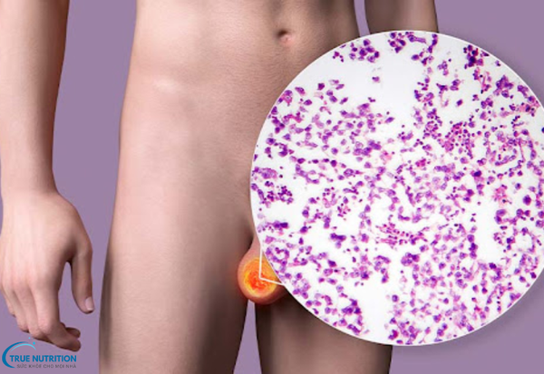 Cách Chữa Bệnh Viêm Tinh Hoàn: Điều Trị Sớm Để Bảo Vệ Sức Khỏe Sinh Sản