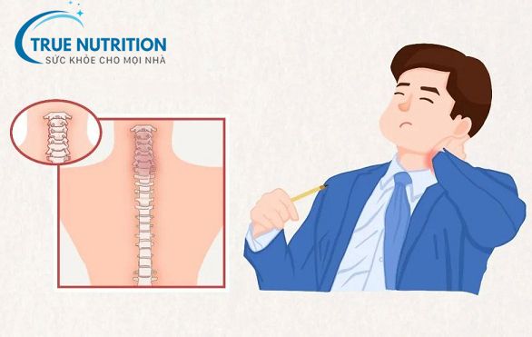 Triệu Chứng Bệnh Thoái Hóa Đốt Sống Cổ
