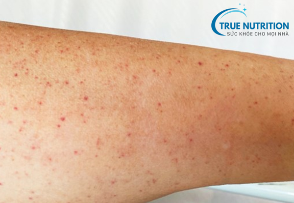 Xuất Huyết Giảm Tiểu Cầu: Triệu Chứng và Biện Pháp Phòng Ngừa