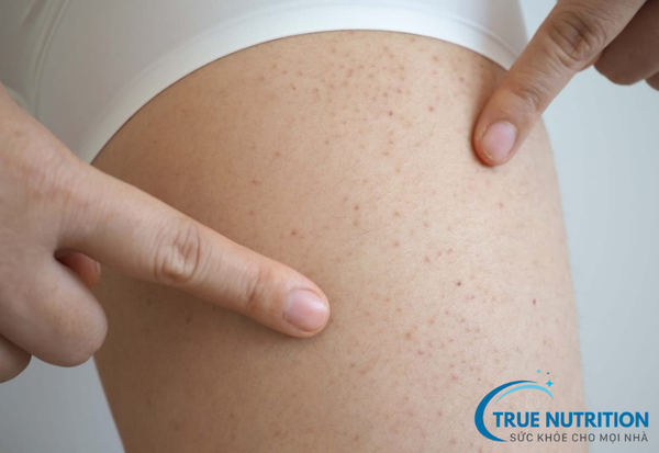 Xuất Huyết Giảm Tiểu Cầu: Triệu Chứng và Biện Pháp Phòng Ngừa