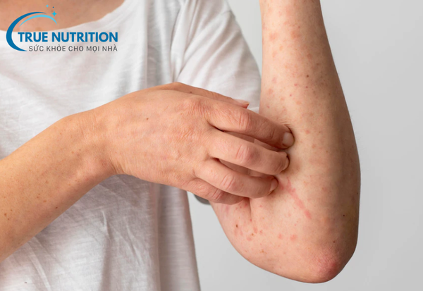 Xuất Huyết Giảm Tiểu Cầu: Triệu Chứng và Biện Pháp Phòng Ngừa