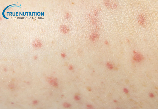 Xuất Huyết Giảm Tiểu Cầu: Triệu Chứng và Biện Pháp Phòng Ngừa