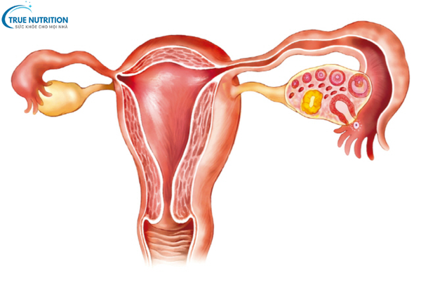 Bệnh U Nang Buồng Trứng: Cách Phát Hiện Sớm Và Giảm Nguy Cơ Biến Chứng