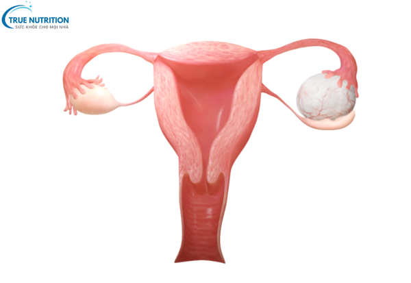 Bệnh U Nang Buồng Trứng: Cách Phát Hiện Sớm Và Giảm Nguy Cơ Biến Chứng